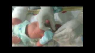 Neonatal Digital Intubation Part 1 [upl. by Pedaias]