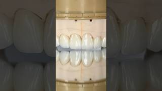 Maxillary Zen Enamel Zirconia Crowns ​⁠EnvisiontecMain envisiontec lsk121shorts dentist [upl. by Pinsky]