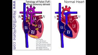 41 Tetralogy of Fallot withOUT pulmonary stenosis [upl. by Annyahs]