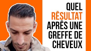 Greffe de cheveux Turquie résultat avant après 12 mois  Turkisme Medical [upl. by Lauber274]