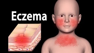 Eczema Animation [upl. by Aistek]