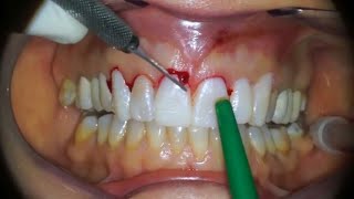 Gingivectomy  Procedure to eliminate suprabony pockets  Dental Clinic [upl. by Delamare]