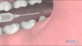 How a wisdom tooth is removed [upl. by Hedelman]