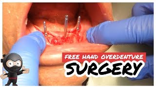 Freehand Overdenture Surgery How to lineup your angles without a guide [upl. by Wardle]