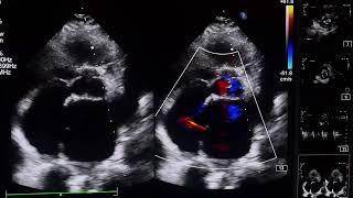 Rheumatic Heart Disease cardiovascular heartcondition rheumatology matoid arthritis [upl. by Missak499]