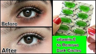 Remove Dark Circles in 3 days with Vitamin E 100 Works [upl. by Karrah]