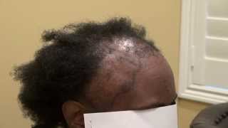 Black Woman Hair Transplant Advanced Hair Loss Pattern Surgery Dr Diep wwwmhtacliniccom [upl. by Gratia324]