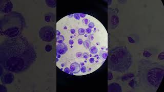 Mesothelial Cells in Pleural Fluid  Body Fluid  Fluids Giemsa Stain [upl. by Hurff]