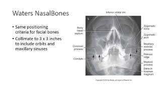 Radiographic Positioning of the Nasal Bones [upl. by Nalo54]