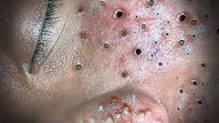 Toltal Best blackheads by Loan Nguyen No ads [upl. by Eylk999]