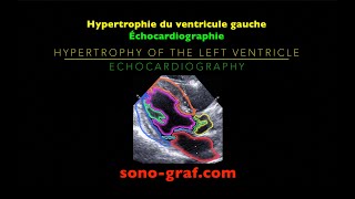 Échocardiographie  Hypertrophie du ventricule gauche [upl. by Ecidnacal]