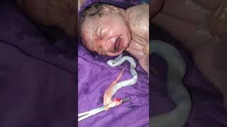 Vernix lot of 2 meters Newborn baby nurse and doctor cleaning it with soap and spinal cords cutt [upl. by Harol]