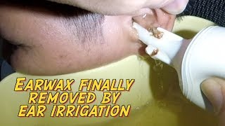 Hard Earwax Finally Removed by Ear Irrigation After 5 days of Ear wax Softener [upl. by Ireland]