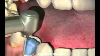 Crowns  Procedure for your new crown at Dental Reflections [upl. by Nnyletak]