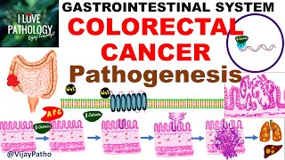 Colorectal carcinoma  Epidemiology risk factors amp Pathogenesis [upl. by Rosette]