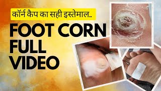 Foot Corn Removal The Ultimate Corn Cap Guide पैर की कील से फ़ौरन निजात पाए ऐसे कॉर्न कैप लगाए [upl. by Ibrahim]