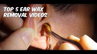 5 Awesome Tips to Remove Ear Wax [upl. by Neryt]