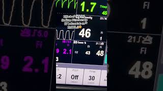 Effect of Fast IV bolus of Sodium Bicarbonate on EtCO2 in Pediatric Cardiac Patient [upl. by Maro862]