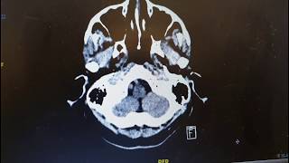 SYNAPSE 101 How to read a CT Brain [upl. by Elsinore]