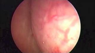 fibrome typ 1 Hysteroscopie Vs echographie 4DUltrasono 4d 3D Managment hysteroscopic Myoma [upl. by Neumark]