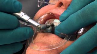 Implant Case 7 Fully Guided Implant Placement with Dr Tarun Agarwal  Part 8 [upl. by Weinstein]