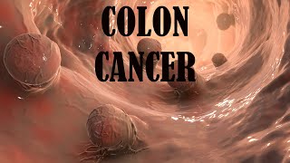 Colon Cancer A Silent Threat for Seniors [upl. by Arul]