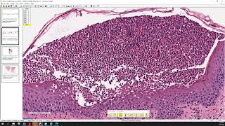 Acute generalized exanthematous pustulosis AGEP pustular psoriasis and SneddonWilkinson [upl. by Magulac732]