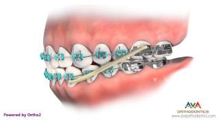 Orthodontics Treatment for Underbite or Crossbite  Rubber Bands [upl. by Hinkel]