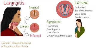 Laryngitis  Symptoms causes and treatment [upl. by Terbecki261]