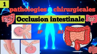 cours S3  Pathologies Chirurgicales et SI  Occlusion Intestinale Aiguë 1 OIA🩺🎯📚شرح سهل و مبسط 📚 [upl. by Buehrer217]