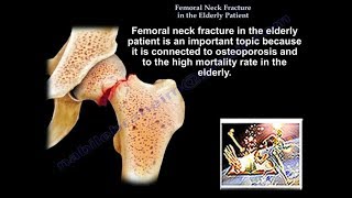 Femoral Neck Fracture In The Elderly Patient  Everything You Need To Know  Dr Nabil Ebraheim [upl. by Nodababus]