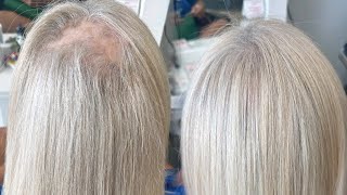 V light hair extension alopecia hair thinning balding  hair extension transformation [upl. by Harned]