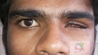 Ocular Prosthesis Before and After [upl. by Mihe]