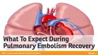 What To Expect During Pulmonary Embolism Recovery [upl. by Sidwohl]