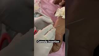 Cannula insertion 👍 shorts hospital cannula injection trending aiims doctor [upl. by Euqinaj]