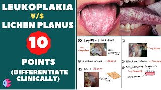 Leukoplakia Vs Lichen planus  Signs of leukoplakia  Signs of lichen planus  Leukoplakia tongue [upl. by Elery487]