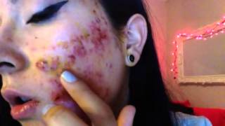 Severe cystic acne accutane week 1 [upl. by Base]