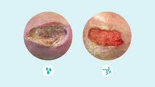 How to assess wound exudate [upl. by Eiruam]