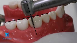 TOOTH PREPARATION FOR ZIRCONIA CROWN [upl. by Weiser218]