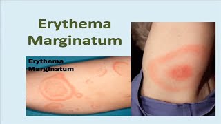 Erythema Marginatum Rash [upl. by Aihsad]