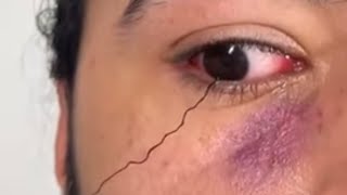 Super Satisfying Ingrown Hair Removal From Eyelid🤯 [upl. by Nawrocki397]