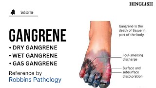 Gangrene  Types of Gangrene  Dry Gangrene  Wet Gangrene  Gas Gangrene  Pathology  KTC MBBS [upl. by Arualana517]