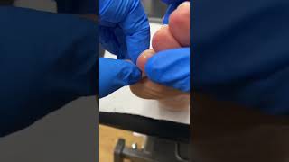 Australian Podiatrist Removes Pinch Callus with Docpods  Effective Callus Removal Techniques [upl. by Marquet]