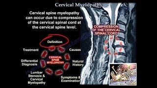 Cervical Myelopathy  Everything You Need To Know  Dr Nabil Ebraheim [upl. by Gregory]