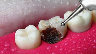 ASMR Restoration Incredible Tooth Cavity And The Master Dentist [upl. by Homans236]