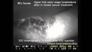 icg lymphography upper limb lymphedema Lymphedema Surgery in Japan [upl. by Ahsaetan135]