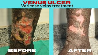 Varicose veins treatment Laser Treatment of varicose venous Ulcer Varicose veins treatment Ranchi [upl. by Talley]