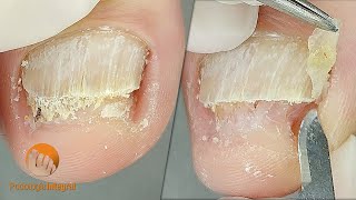 2 cases 1 video XI  1 Onychomycosis  2 Onychogryphosis Podological treatment [upl. by Hetty938]