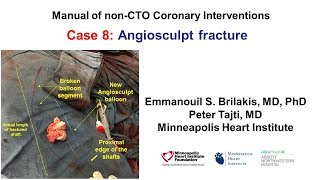 Case 8 PCI Manual  Angiosculpt balloon fracture [upl. by Yellehs]