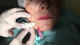 DrAvaliani performing Instant Thread Lift using NovaThreads [upl. by Ahkos]